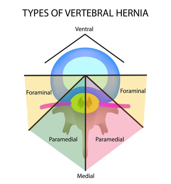 Helyét az intervertebralis Sérv típusok. Elszigetelt háttér vektor illusztráció. — Stock Vector