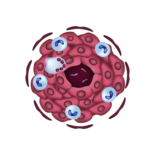 La structure des granulomes tuberculeux. Illustration vectorielle sur fond isolé — Image vectorielle