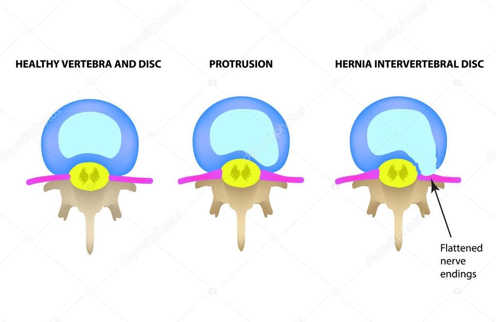 Protrusion of the intervertebral disc. Hernia. Vector illustration on isolated background.