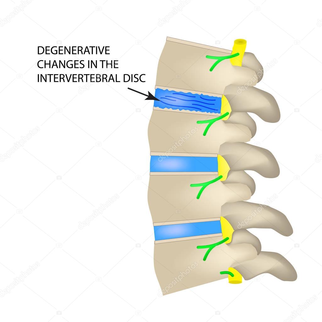 Degenerative changes in the intervertebral disc. Vector illustration on isolated background