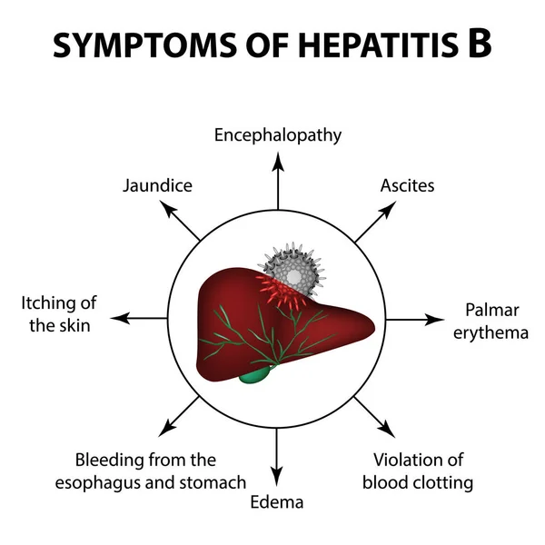 Síntomas de hepatitis B. Hígado. Día Mundial de la Hepatitis. 28 de julio. Infografías. Ilustración vectorial sobre fondo aislado — Vector de stock