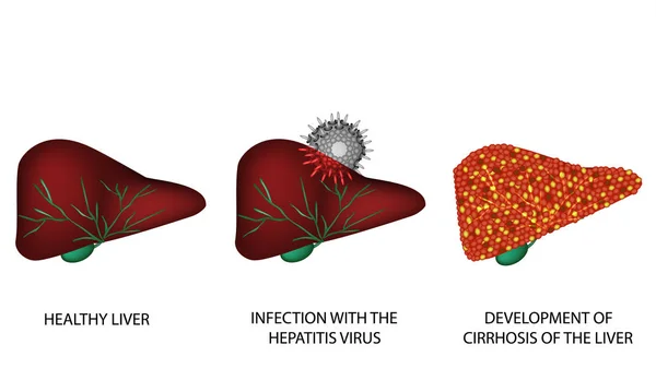 Consecuencias de la hepatitis. Cirrosis del hígado. Día Mundial de la Hepatitis. 28 de julio. Infografías. Ilustración vectorial sobre fondo aislado — Vector de stock