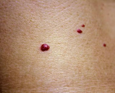 Angioma. Cilt yüzeyindeki kırmızı doğum lekesi