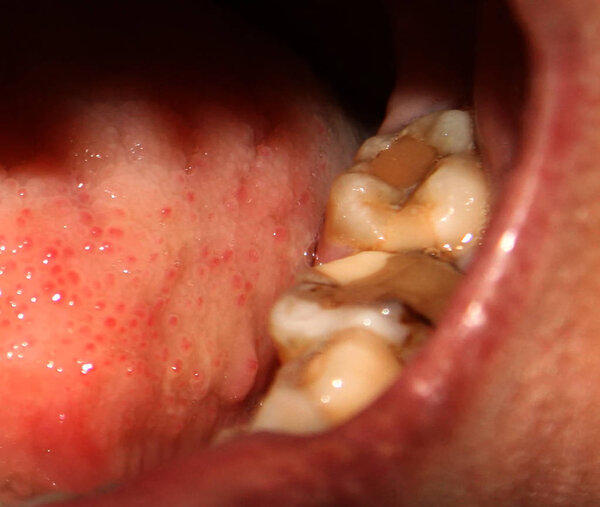 Пломбы в зубах. Лечение кариеса зубов
.