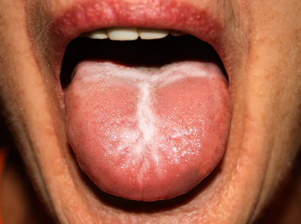 念珠菌病的舌头。白色的涂料。鹅口疮. — 图库照片