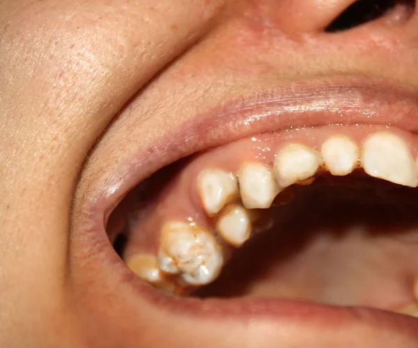 Kromme tanden. Orthodontie. Onderontwikkeling en gebreken van tanden. — Stockfoto