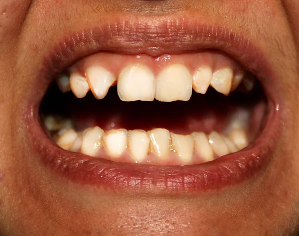 Kromme tanden. Orthodontie. Onderontwikkeling en gebreken van tanden. — Stockfoto