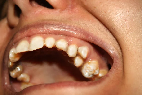 弯曲的牙齿。口腔正畸学。不发达和缺损患牙. — 图库照片