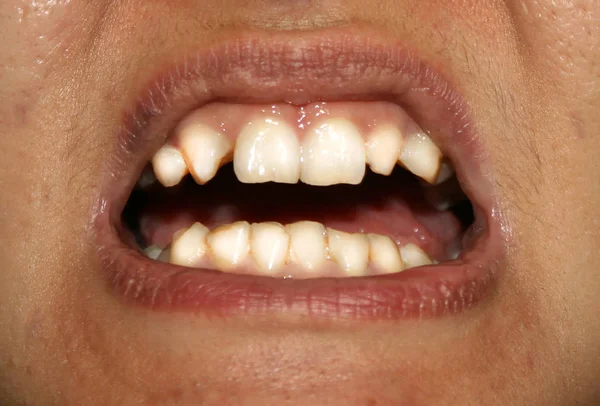 Kromme tanden. Orthodontie. Onderontwikkeling en gebreken van tanden. — Stockfoto