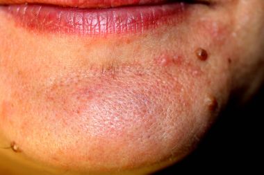 Çenesini üzerinde doğum lekesi. Bir köstebek yüz cilt üzerinde.