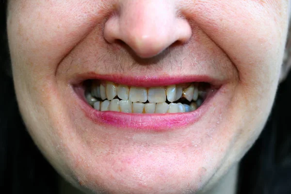 Krzywe zęby w jamie ustnej. Ortodoncja. Wady zgryzu. — Zdjęcie stockowe