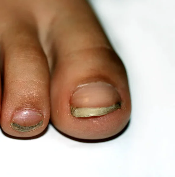 Des ongles sur les pieds, sale. Des ongles d'orteils. ongles sales noirs . — Photo