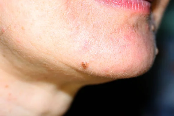 Closeup De Labios Hombre Problema Salud Herpes Simple Fotos De