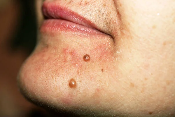 Moedervlek op zijn kin. Een mol op de huid van het gezicht. — Stockfoto