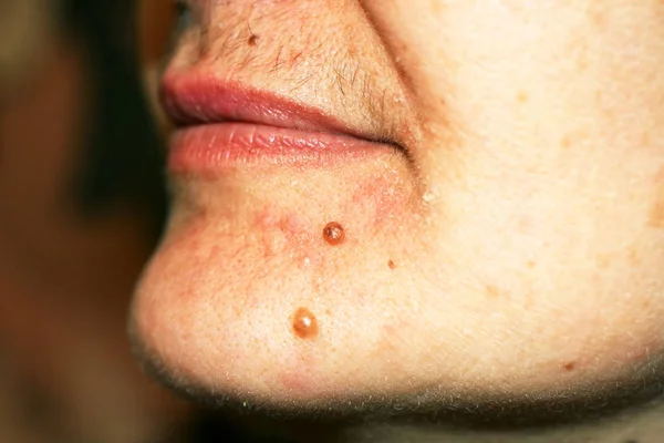 Birthmark on his chin. A mole on the skin of the face. — Stock Photo, Image