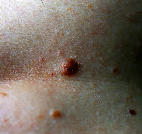 Topo en la piel del cuerpo. Marca de nacimiento. Acrocordón . — Foto de Stock