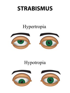 Şaşılık. Hypertropia. Hypotropia. Infographics. Vektör illüstrasyon izole arka plan üzerinde