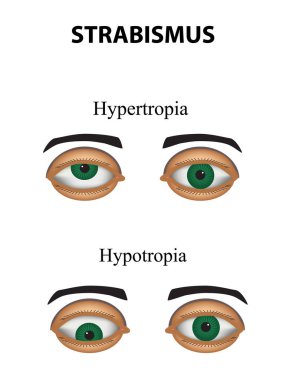 Strabismus. Hypertropia. Hypotropia. Infographics. Vector illustration on isolated background clipart