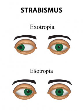 Strabismus. Esotropia. Exotropia. Infographics. Vector illustration on isolated background. clipart