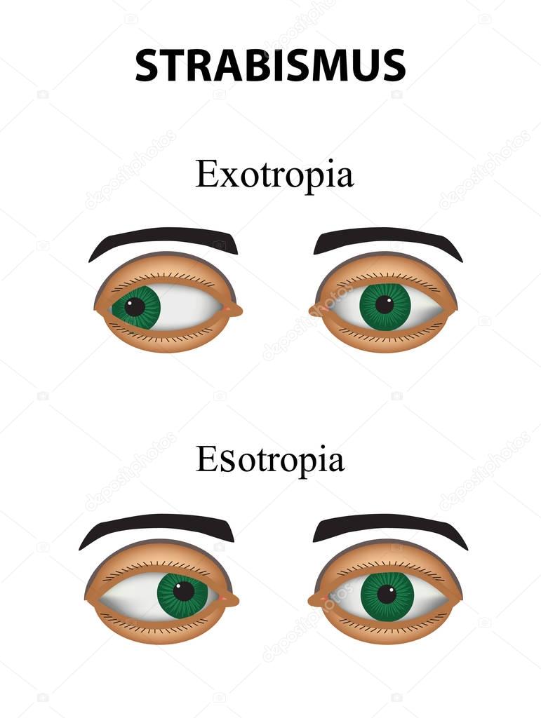 Strabismus. Esotropia. Exotropia. Infographics. Vector illustration on isolated background.