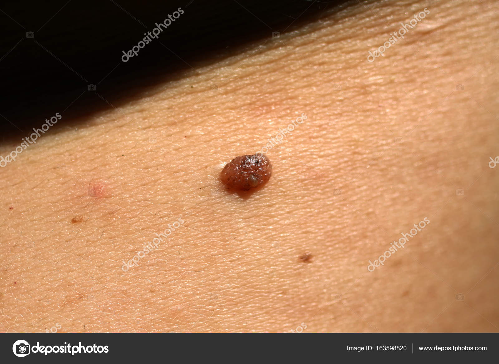 grain de beauté verruqueux naevus verruqueux traitement TURJN