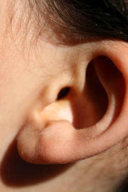 Deforme kulak. Anormal gelişimi lobülü. Estetik cerrahi ve kozmetik