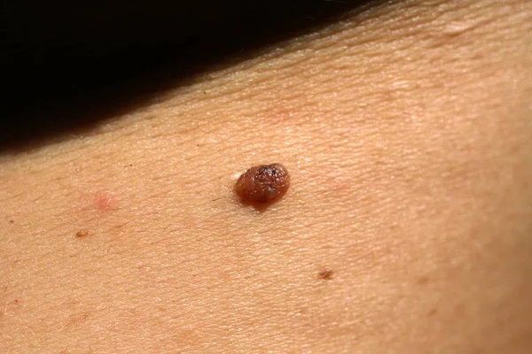 Mole on the skin of the body. Birthmark. Acrochordon.