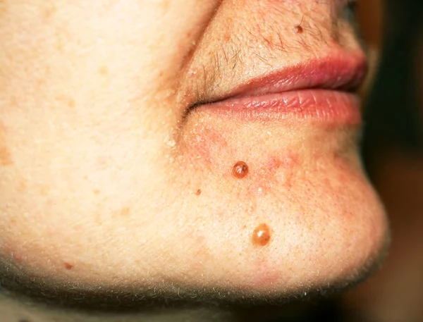 Birthmark on his chin. A mole on the skin of the face. — Stock Photo, Image