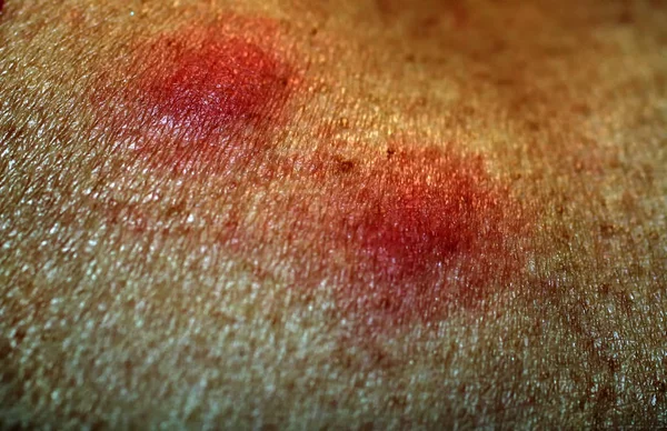 红蚊叮咬。皮肤肿胀。一只黄蜂, 一只蜜蜂. — 图库照片