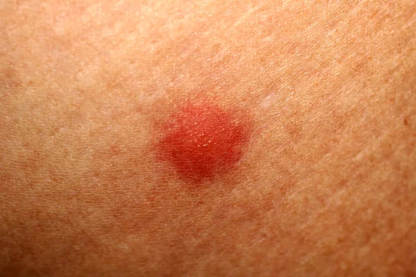 Picaduras de mosquitos rojos. Hinchazón de la piel. Un mordisco de avispa, una abeja . — Foto de Stock