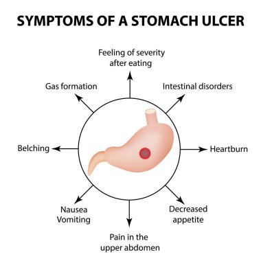 Symptoms of a stomach ulcer. Infographics. Vector illustration on isolated background clipart