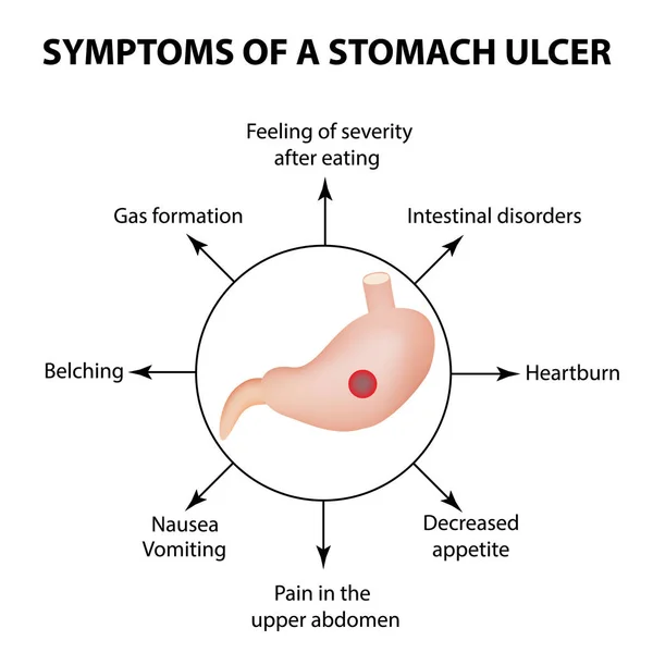 Symptome eines Magengeschwürs. Infografiken. Vektor-Illustration auf isoliertem Hintergrund — Stockvektor