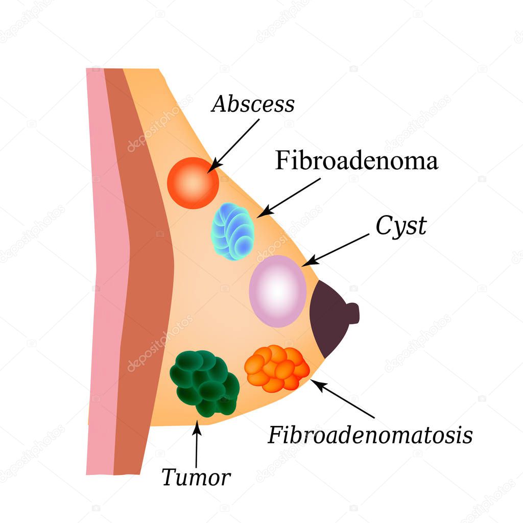 Fibroadenomatosis, Fibroadenoma, Abscess, Tumor, Cyst in the mammary gland. World Breast Cancer Day. Vector illustration on isolated background