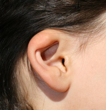 Deforme kulak. Anormal gelişimi lobülü. Estetik cerrahi ve kozmetik