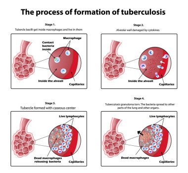 The process of tuberculosis formation. Infographics. Vector illustration on isolated background. clipart