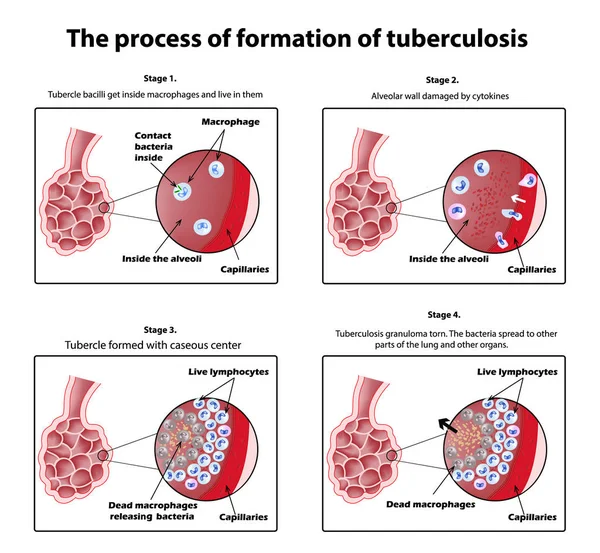 結核の形成過程。インフォ グラフィック。孤立した背景のベクトル図. — ストックベクタ