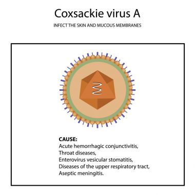 Coxsackie virüs A. hastalığın belirtileri yapısı. Enterovirüslerin. Infographics. Vektör illüstrasyon izole arka plan üzerinde