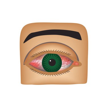Conjunctivitis. Redness and inflammation of the eye. Vessels in the eye. Infographics. Vector illustration on isolated background clipart