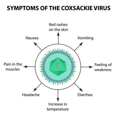 Coxsackie virüs enfeksiyonu belirtileri. Enterovirüslerin. Infographics. Vektör illüstrasyon izole arka plan üzerinde