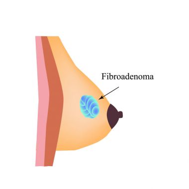 Meme bezinde fibroenom var. Dünya Göğüs Kanseri Günü. İzole edilmiş arkaplanda vektör illüstrasyonu