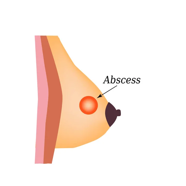 Ascesso nella ghiandola mammaria. Giornata mondiale del cancro al seno. Illustrazione vettoriale su sfondo isolato — Vettoriale Stock