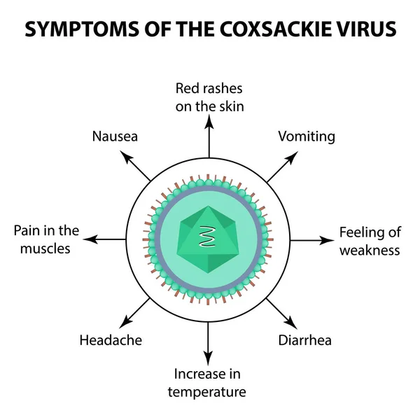 Symptoms of infection Coxsackie virus. Enterovirus. Infographics. Vector illustration on isolated background — Stock Vector