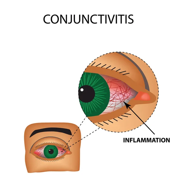 Konjunktivit. Rodnad och inflammation i ögat. Blodkärl i ögat. Infographics. Vektorillustration på isolerade bakgrund — Stock vektor