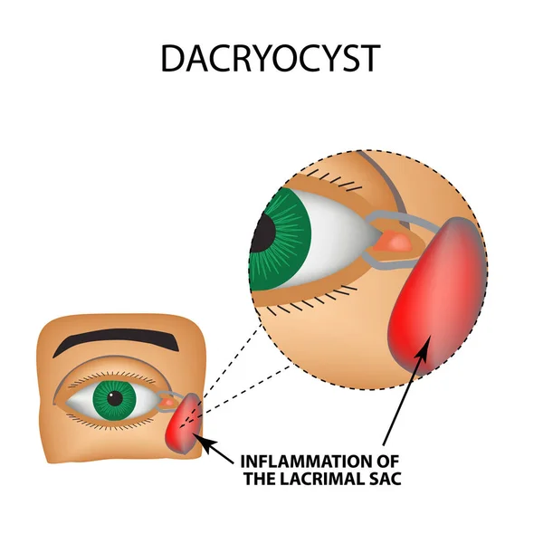 Dacryocyst입니다. 눈의 눈물 주머니의 염증입니다. 눈의 구조입니다. 인포 그래픽입니다. 격리 된 배경에서 벡터 일러스트 레이 션 — 스톡 벡터