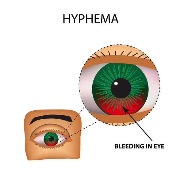 Hyphema. Pendarahan mata anterior. Struktur dari mata. Infografis. Ilustrasi vektor pada latar belakang terisolasi - Stok Vektor