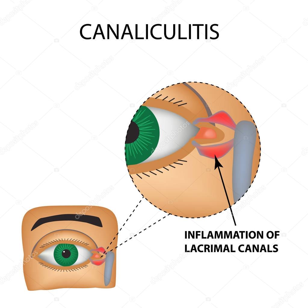 Canaliculitis. Inflammation of lacrimal canals. The structure of the eye. Infographics. Vector illustration on isolated background