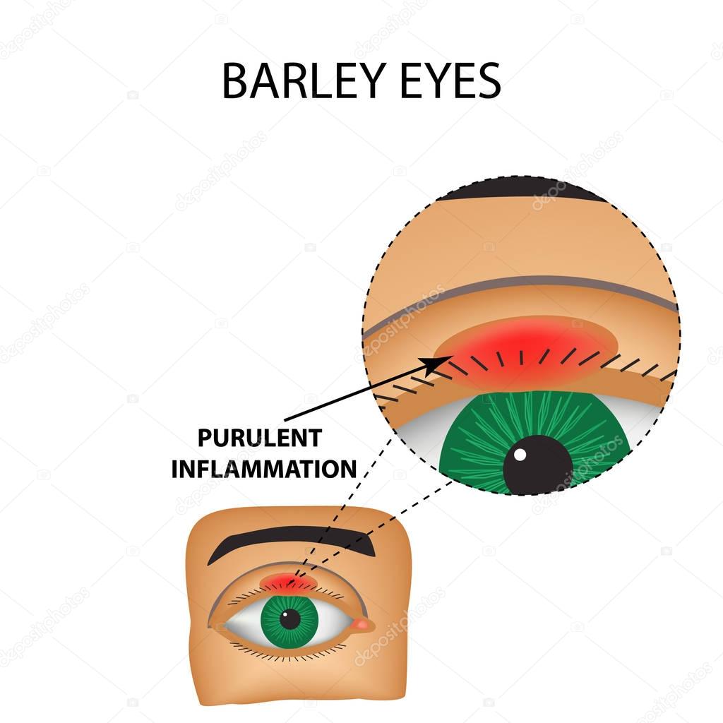 Barley eyes. Purulent inflammation. The structure of the eye. Infographics. Vector illustration on isolated background