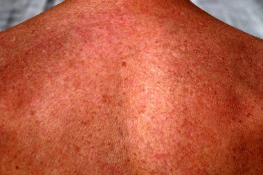 Pigmentasyon omuz ve arka. Kahverengi benekli cilt. Çiller