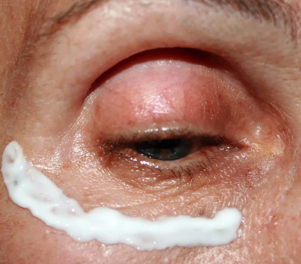 De toepassing van de rimpel crème onder de ogen. Rimpels op het ooglid. — Stockfoto