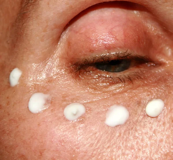 Gözlerinin altında Kırışıklık krem uygulama. Göz kapağı kırışıklıkları.